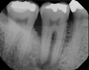 Tooth # 31 Note the small filling and abscess on distal root.