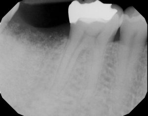 implant site